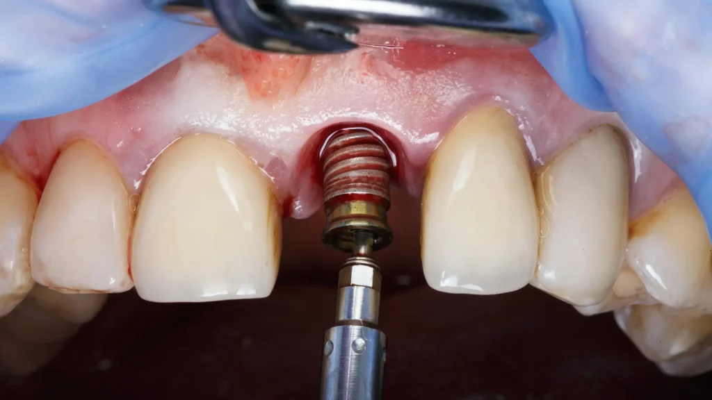 Articol Implant