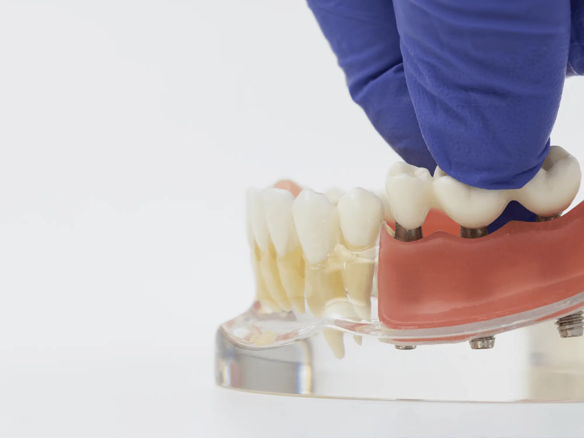 Restaurări Dentare (2)